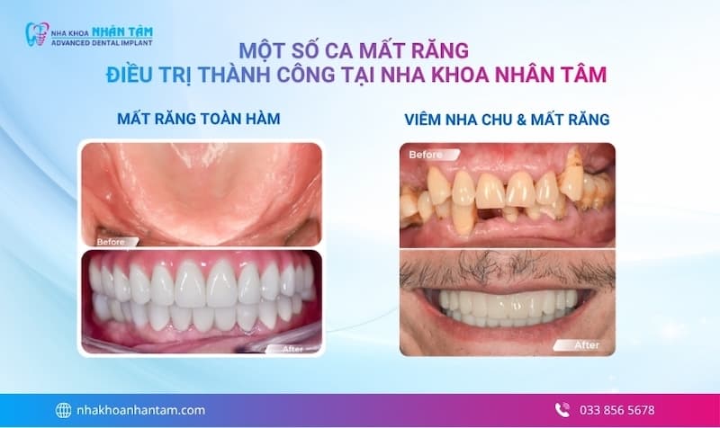 hậu quả của mất răng