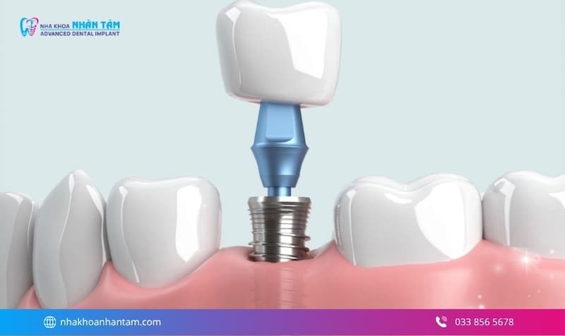 mất 1 răng có cần trồng lại không