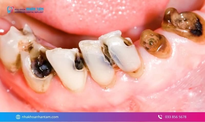 mất răng ảnh hưởng ăn nhai