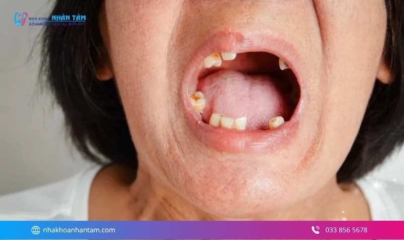 mất răng ảnh hưởng thẩm mỹ