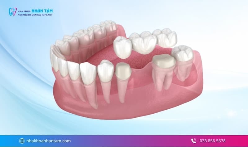 mất răng lâu không trồng lại có sao không