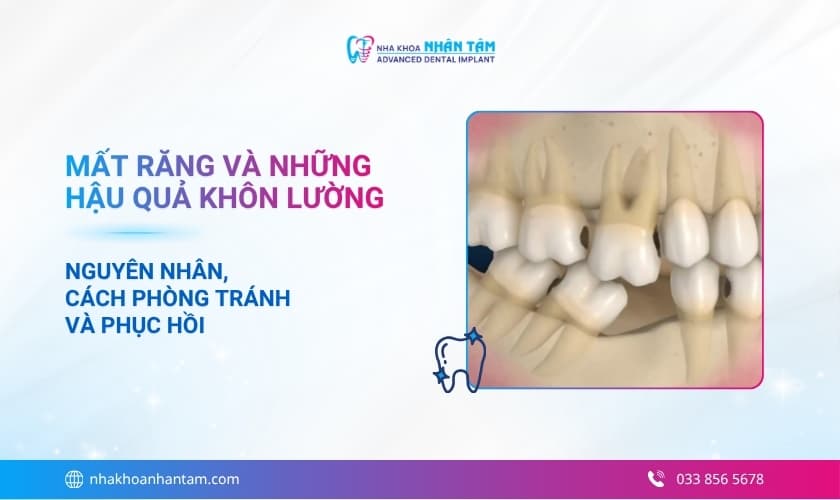 Mất răng: Nguyên nhân, hậu quả và cách phục hồi hiệu quả