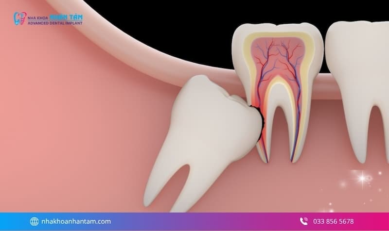 trồng răng cho người mất răng