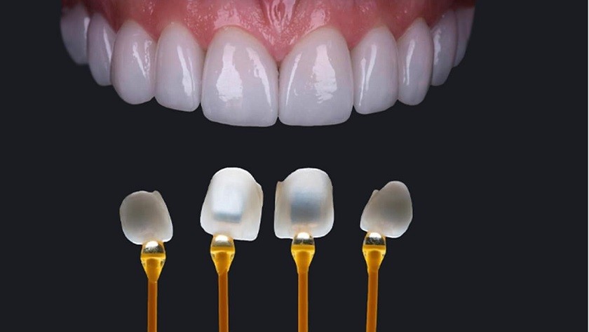 Hình: Mặt dán sứ veneer có màu sắc gần giống răng thật