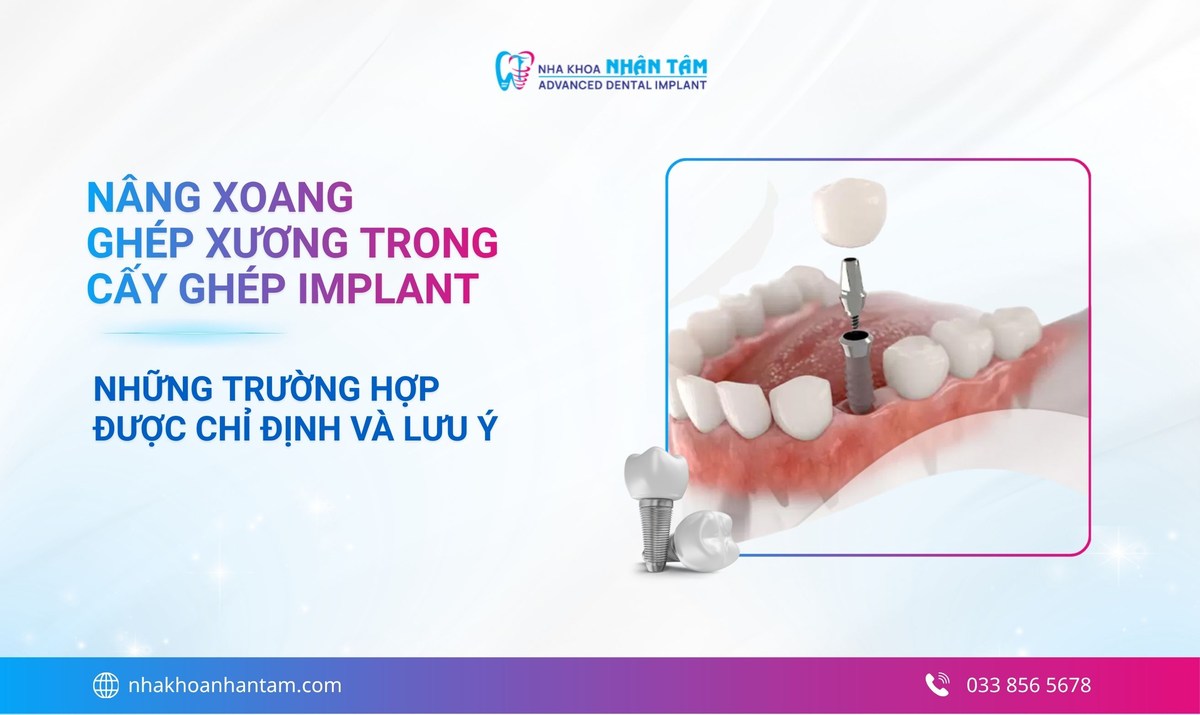 Nâng xoang trong cấy ghép Implant là gì? Khi nào cần thực hiện?