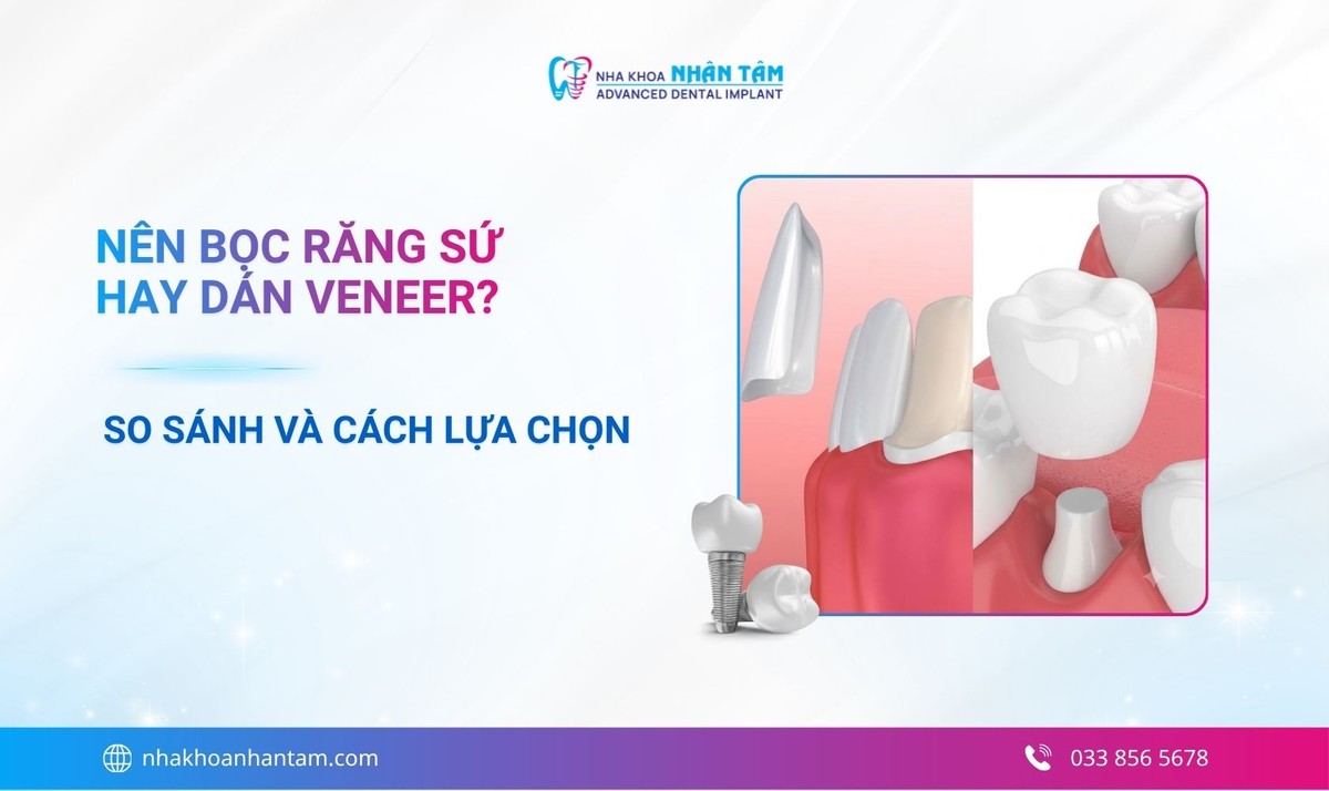 Nên bọc răng sứ hay dán Veneer? So sánh và cách lựa chọn 