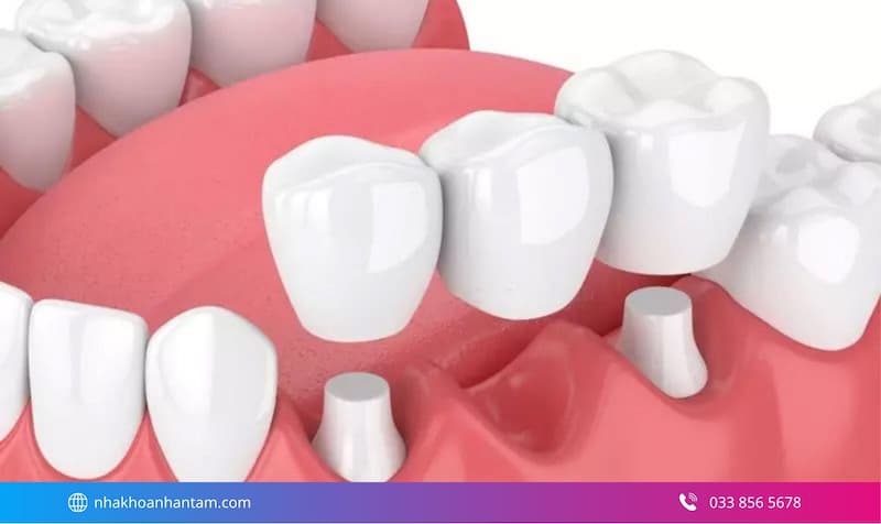nên chọn cầu răng sứ hay implant