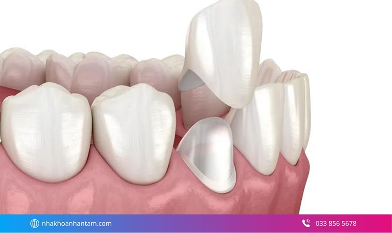 nên chọn răng sứ nào tốt nhất