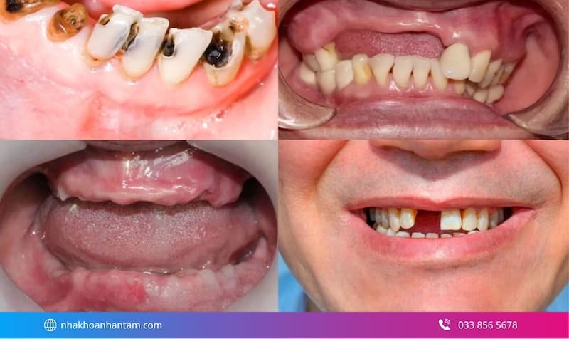 nên làm cầu răng hay trồng implant