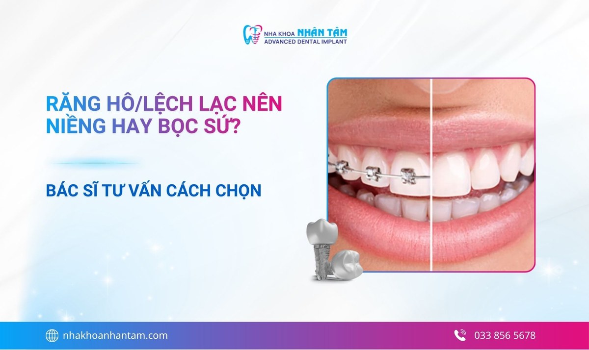 Răng hô/lệch lạc nên niềng hay bọc sứ? Bác sĩ tư vấn cách chọn