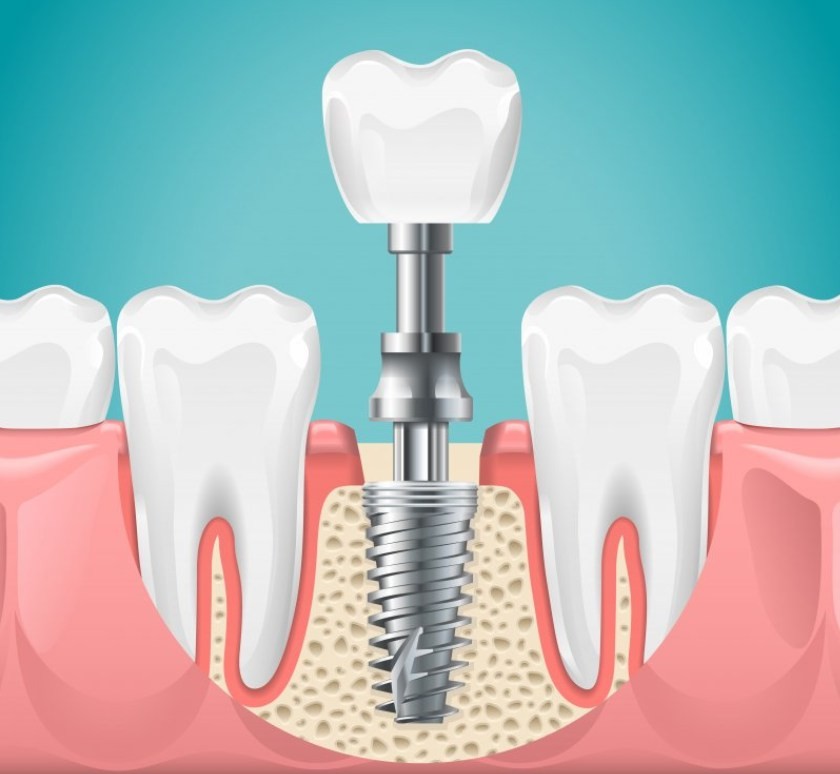 Hình: Kỹ thuật phẫu thuật thiếu chính xác, chất lượng xương kém hoặc chịu lực nhai quá sớm có thể khiến trụ implant bị xê dịch