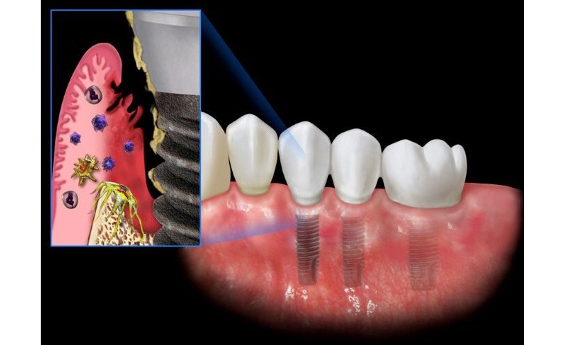 Hình: Tích tụ mảng bám vi khuẩn, sai sót kỹ thuật hoặc thói quen sinh hoạt là những nguyên nhân chính gây viêm quanh implant