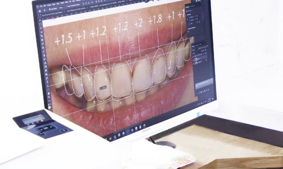 Bọc răng sứ sai kỹ thuật hoặc hở vi kẽ là một trong những nguyên nhân phổ biến gây nhiễm trùng Hình: Bọc răng sứ sai kỹ thuật hoặc hở vi kẽ là một trong những nguyên nhân phổ biến gây nhiễm trùng