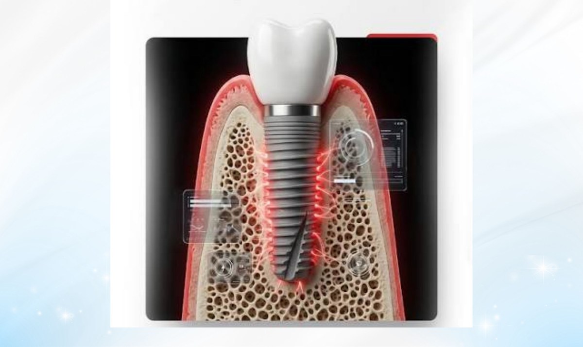 Hình: Các nhóm nguyên nhân chính dẫn đến sự thất bại của ca phẫu thuật cấy ghép implant
