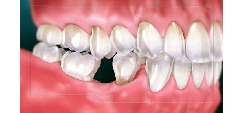 Hình: Nhiễm trùng implant là tình trạng vi khuẩn xâm nhập gây sưng viêm nướu và làm tiêu phần xương nâng đỡ quanh trụ
