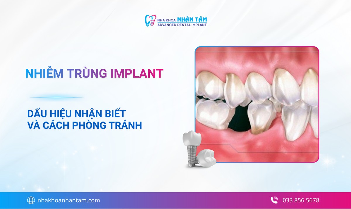 Nhiễm trùng Implant là gì? Nguyên nhân, dấu hiệu và cách điều trị