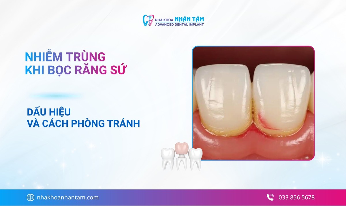 Nhiễm trùng sau khi bọc răng sứ: Nguyên nhân, dấu hiệu và cách xử lý