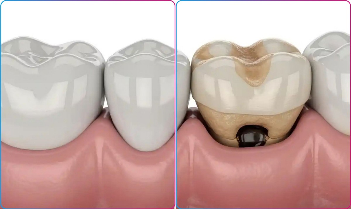 Nhiễm trùng xảy ra khi vi khuẩn tấn công vùng nướu và chân răng sau khi thực hiện phục hình sứ Hình: Nhiễm trùng xảy ra khi vi khuẩn tấn công vùng nướu và chân răng sau khi thực hiện phục hình sứ