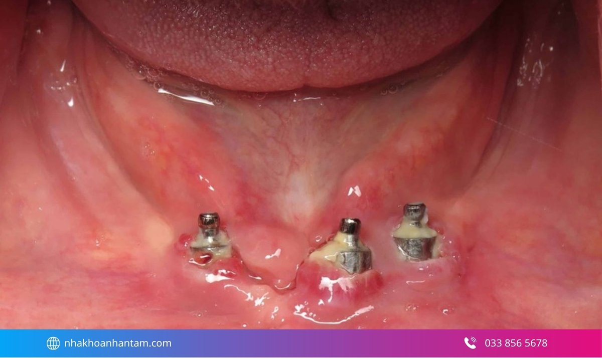 Hình: Nguy cơ nhiễm trùng và viêm quanh Implant nếu không được chăm sóc răng miệng kỹ