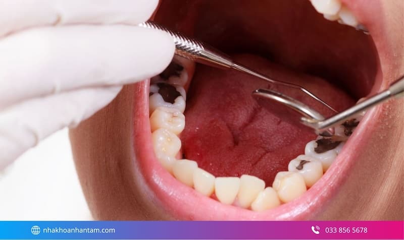 nhổ răng an toàn