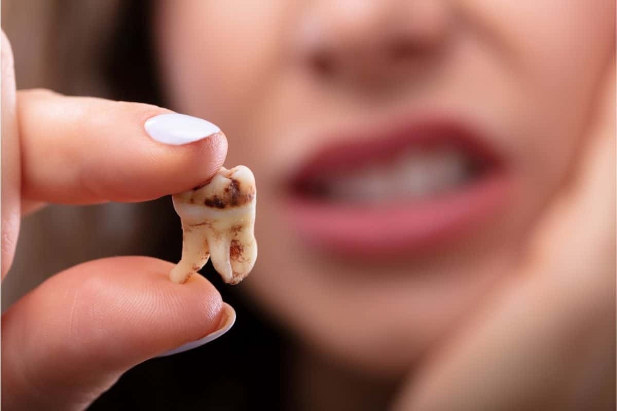 Hình: Nhổ răng khôn bị sâu là giải pháp giúp bảo vệ sức khỏe toàn hàm