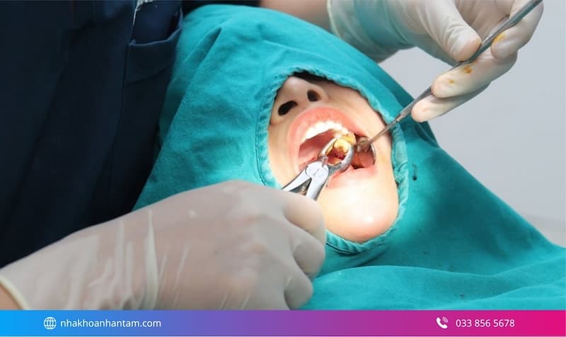 nhổ răng khôn không đau cho người nhạy cảm