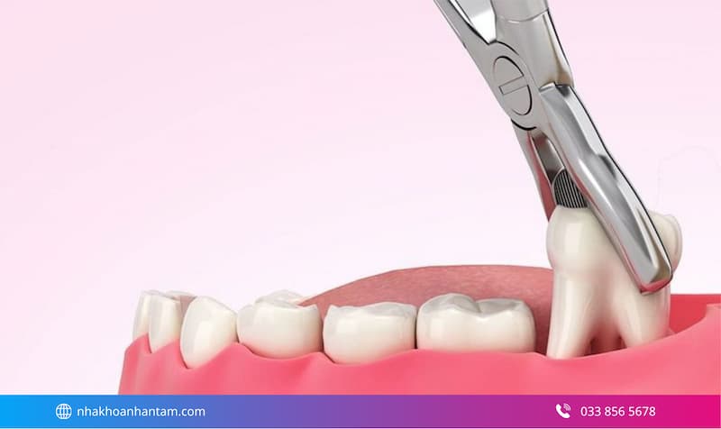 nhổ răng số 8 mất bao lâu