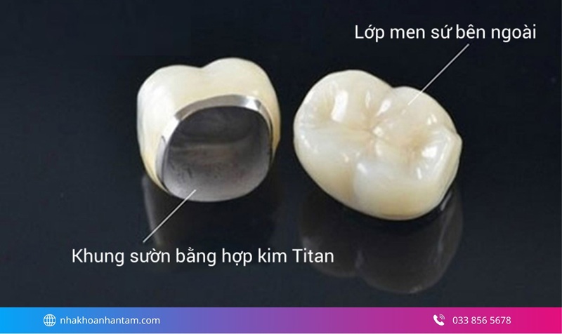 nhược điểm bọc răng sứ