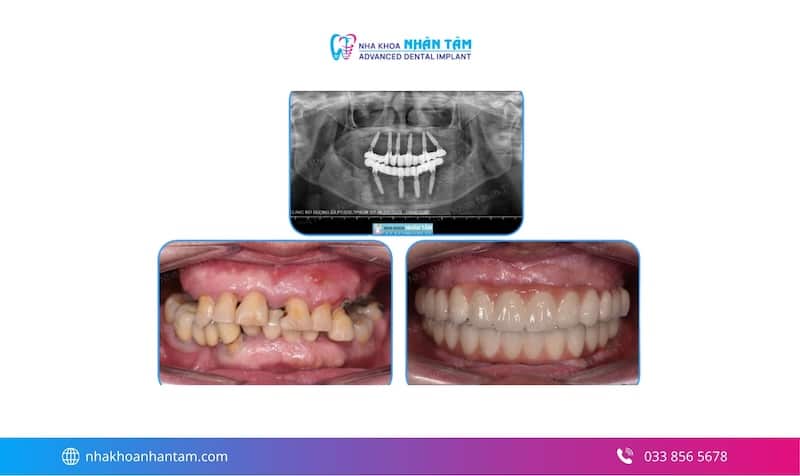 nhược điểm implant all on 4