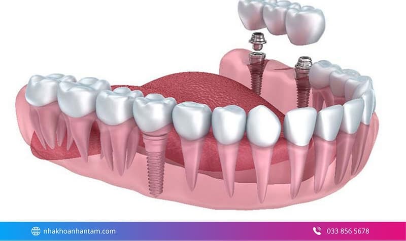 nhược điểm implant nobel