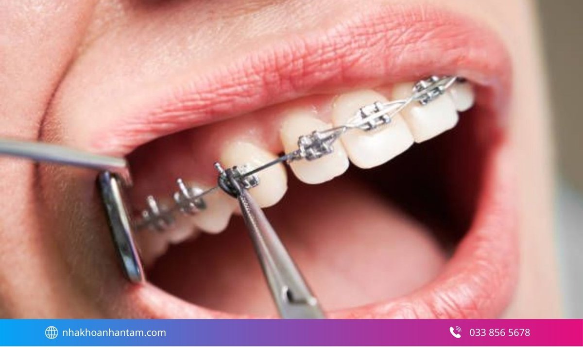 Răng thưa có thể được cải thiện bằng niềng răng Hình: Răng thưa có thể được cải thiện bằng niềng răng