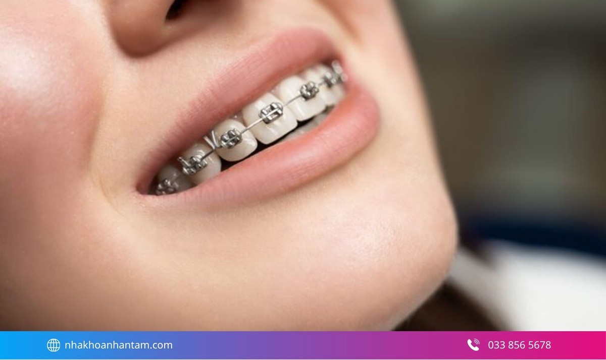 Hình: Niềng răng là phương pháp chỉnh nha để dịch chuyển răng về vị trí phù hợp trên cung hàm