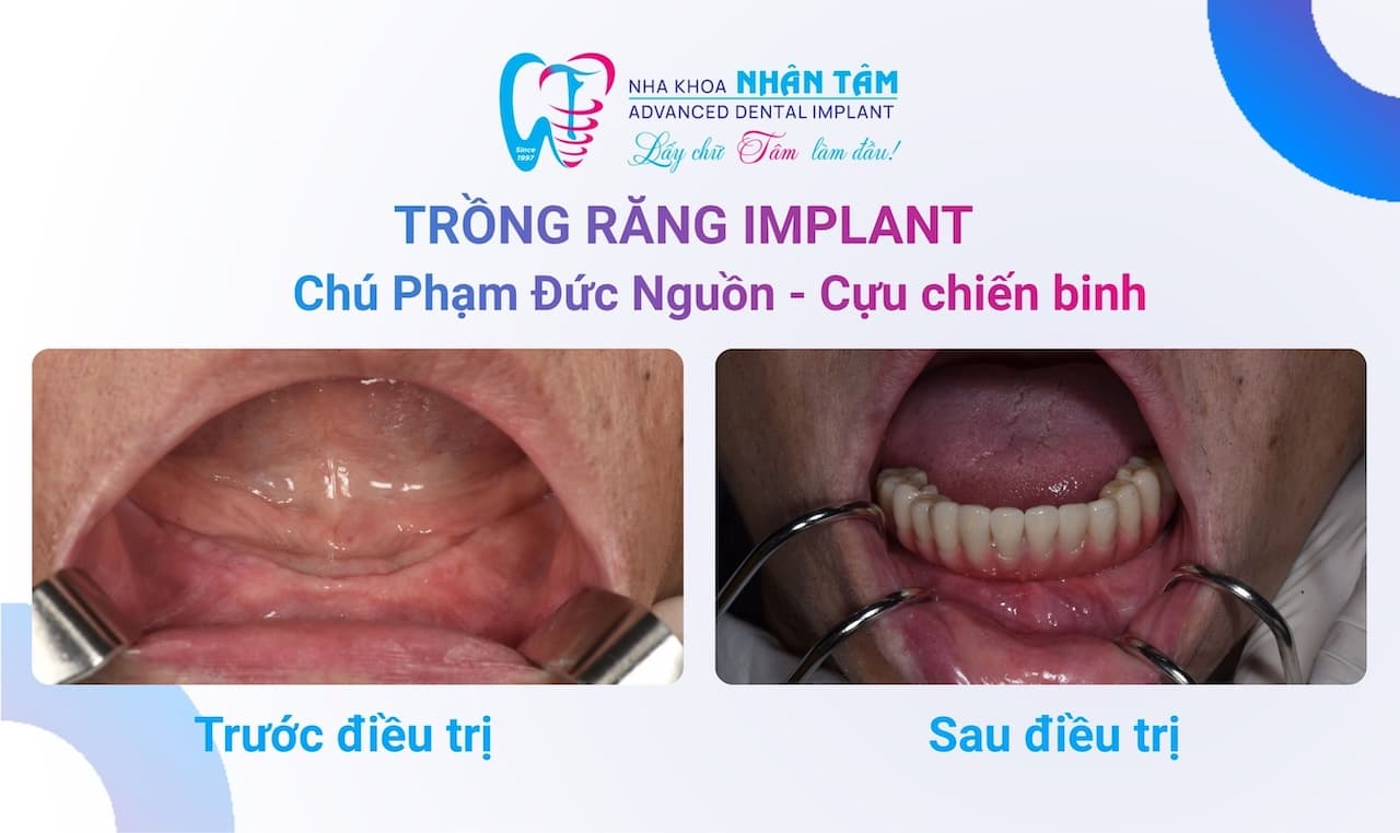 Nỗi Lòng Của Người Cựu Chiến Binh - Chiến Trường Gian Khổ, Răng Lợi Không Còn