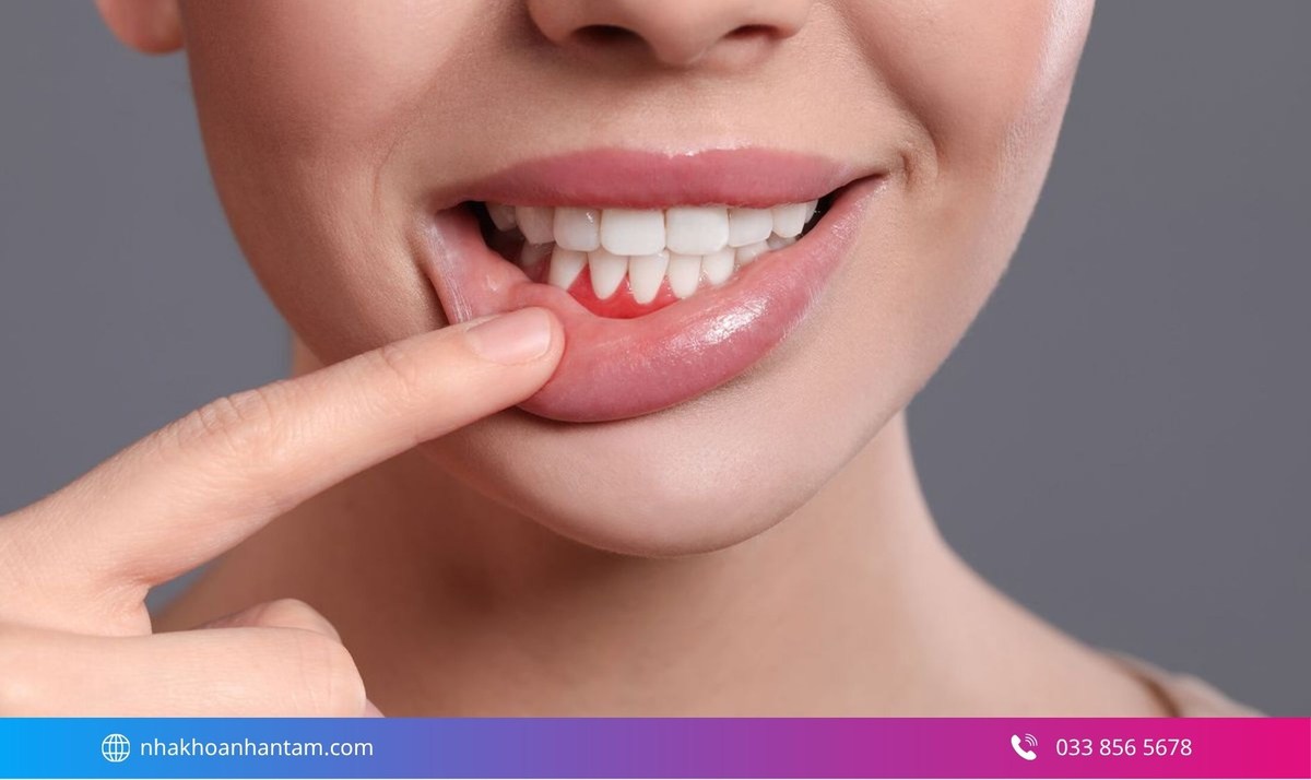 Mô nướu quanh răng dán Veneer bị sưng đỏ có thể là dấu hiệu cho thấy Veneer có thể bị hở hoặc dán lỗi Hình: Mô nướu quanh răng dán Veneer bị sưng đỏ có thể là dấu hiệu cho thấy Veneer có thể bị hở hoặc dán lỗi