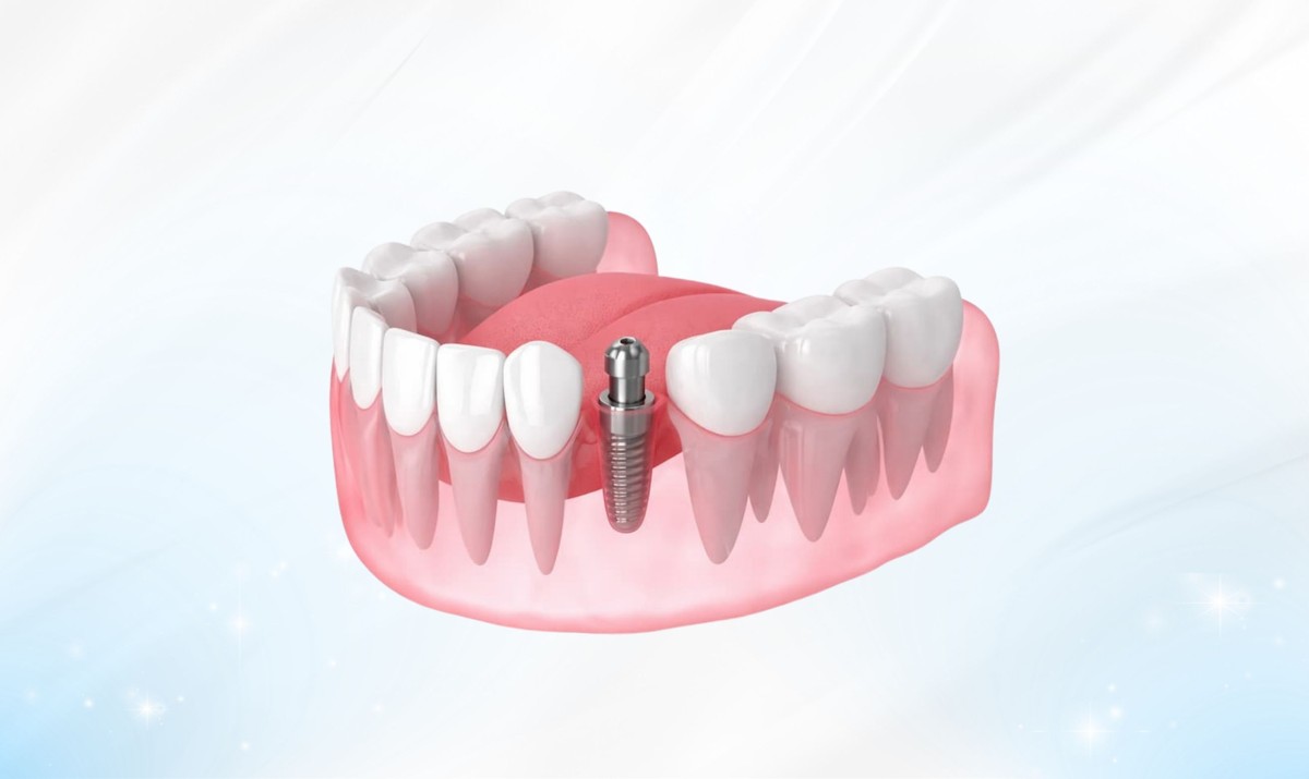 Hình: Bác sĩ sẽ tư vấn loại răng tạm phù hợp theo vật liệu (Acrylic, Composite, PMMA) và hình thức phục hình cho từng khách hàng