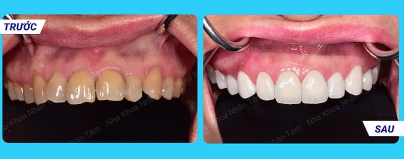 phòng khám răng sứ uy tín khu vực tphcm