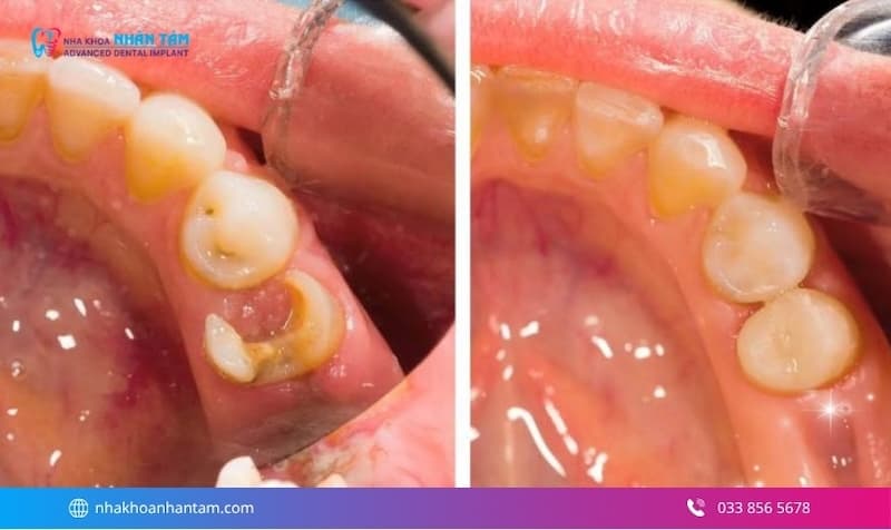 phục hình răng bị sâu