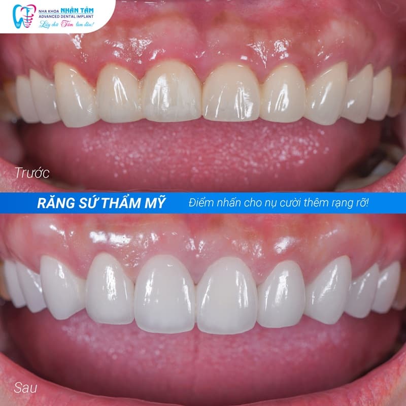 phương pháp làm đẹp răng bằng sứ