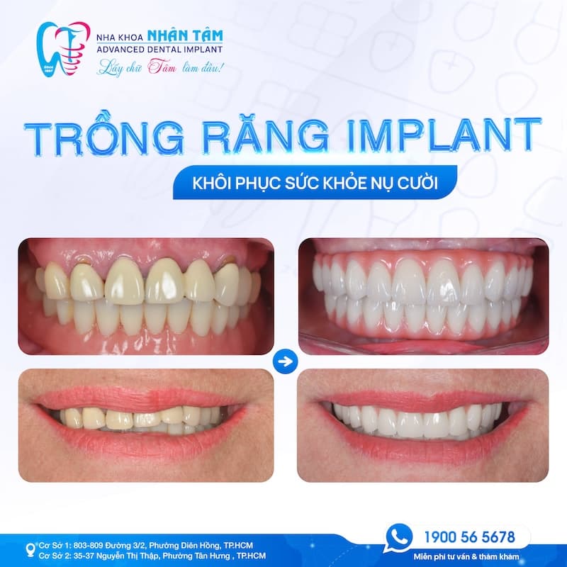 quy trình cấy ghép implant