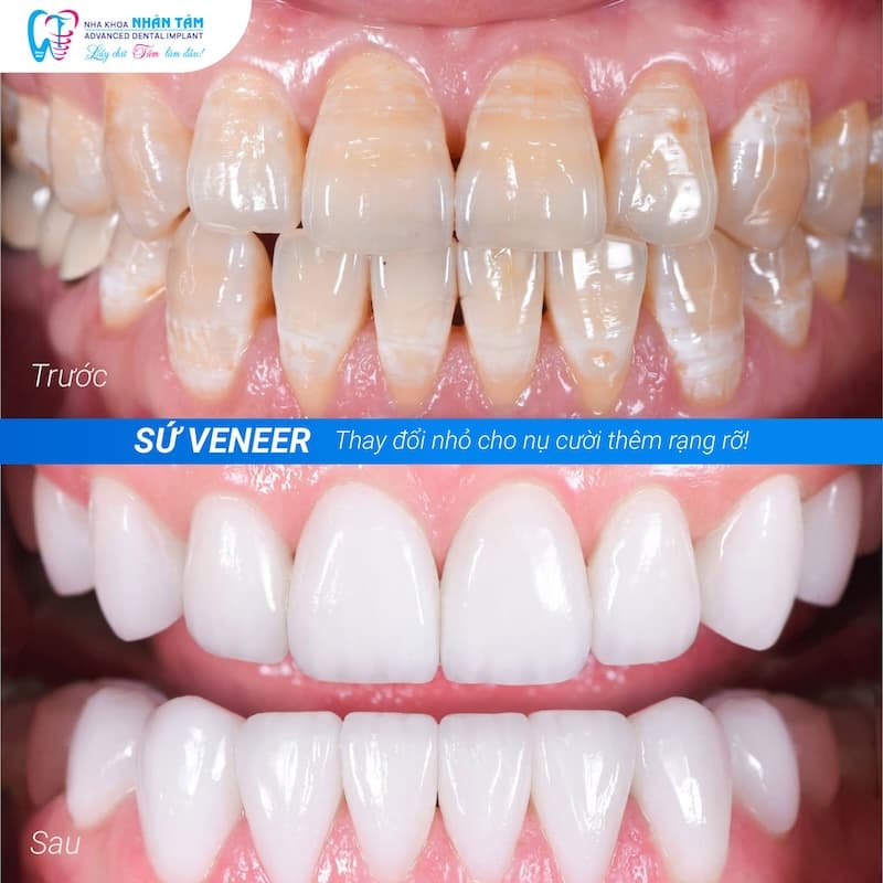 các bước dán sứ veneer