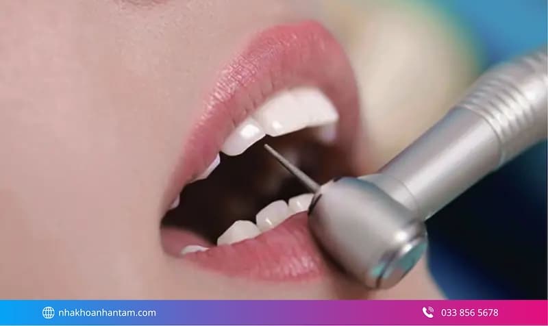 quy trình dán mặt sứ veneer