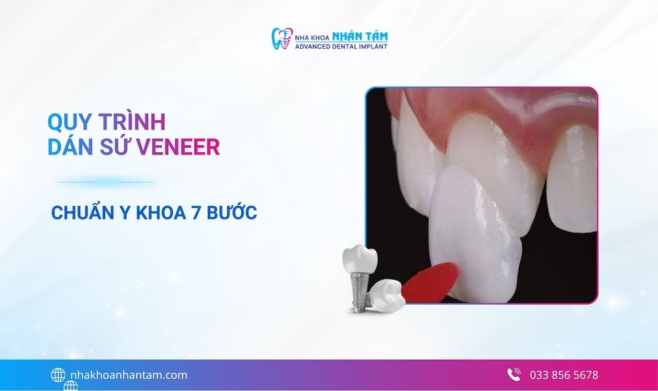 Quy trình dán sứ Veneer chuẩn y khoa 7 bước chi tiết 2026