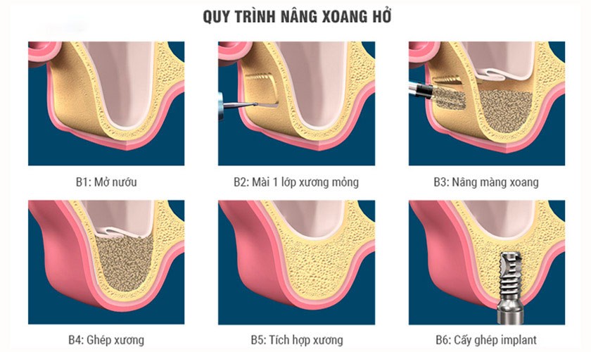 Hình: Quy trình nâng xoang hở 6 bước chuẩn Y khoa giúp kiến tạo thể tích xương phù hợp cho các ca tiêu xương nghiêm trọng