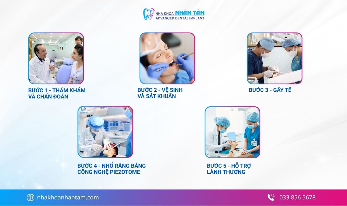 Hình: Quy trình nhổ răng cửa tham khảo