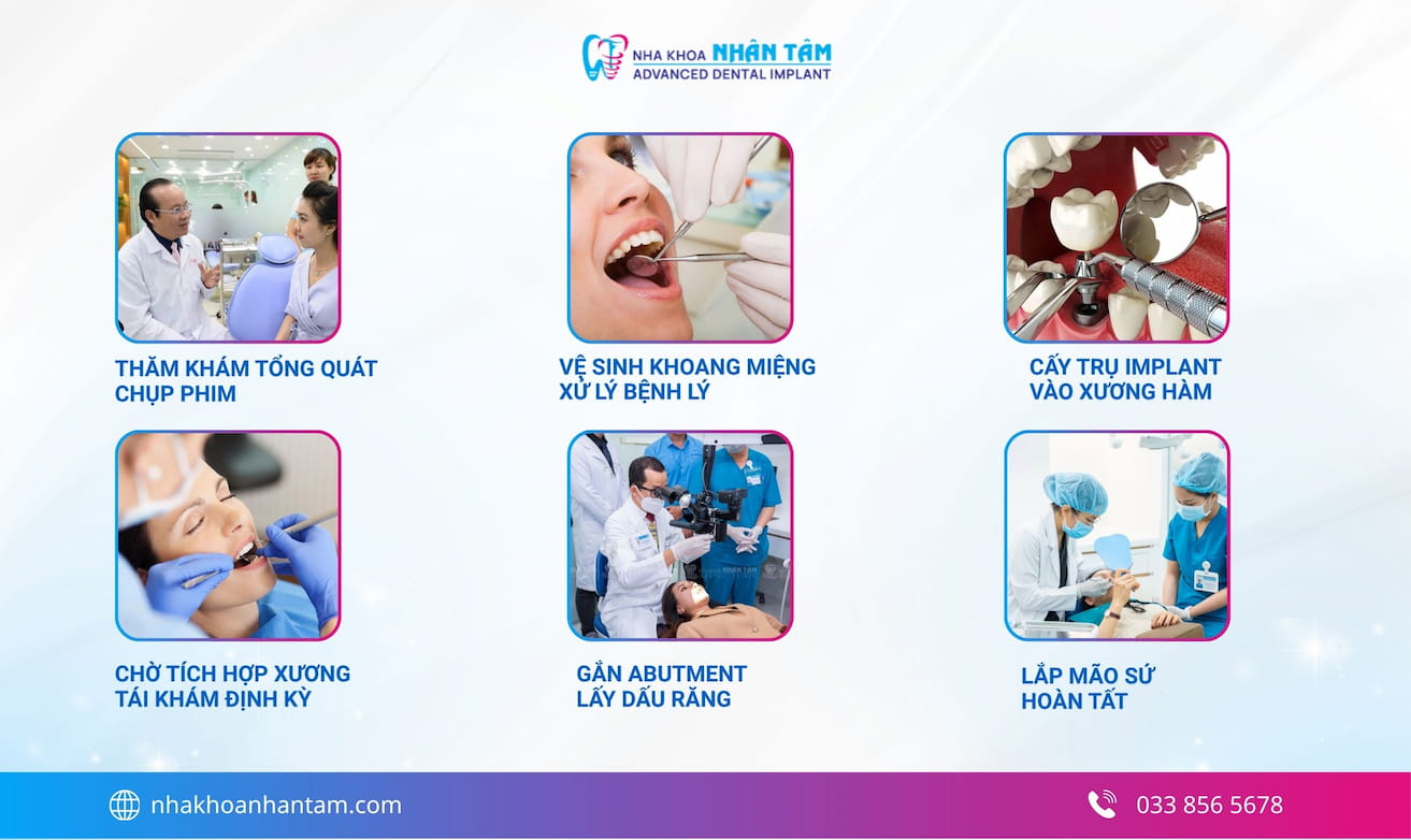 Hình: Quy trình trồng răng Implant chuẩn y khoa