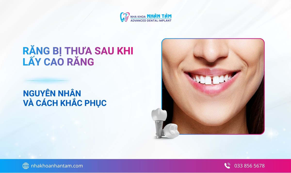 Răng bị thưa sau khi lấy cao răng: Nguyên nhân và cách khắc phục