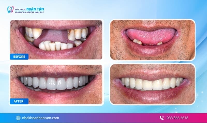 răng giả tháo lắp là gì