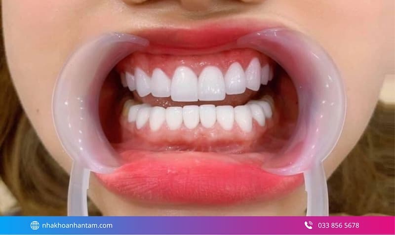 răng hô làm sứ có hiệu quả không