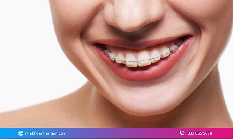 răng hô nhẹ có nên bọc sứ