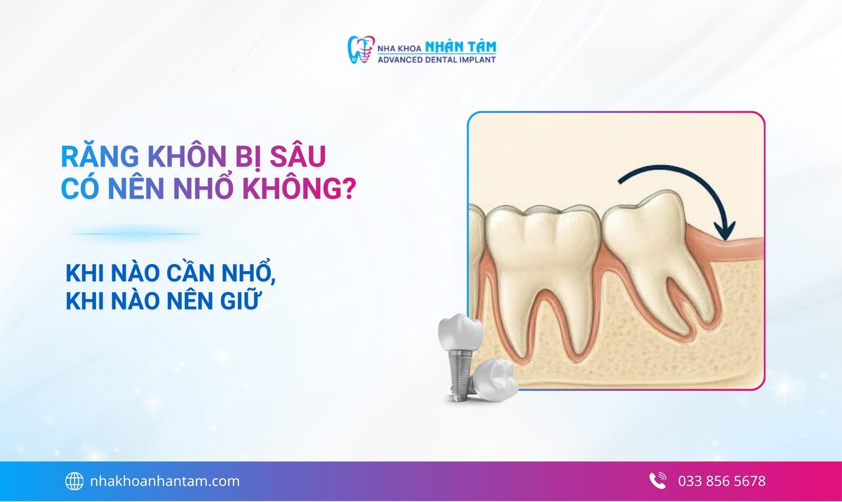 Răng khôn bị sâu có nên nhổ không? Khi nào cần nhổ, khi nào có thể giữ lại?